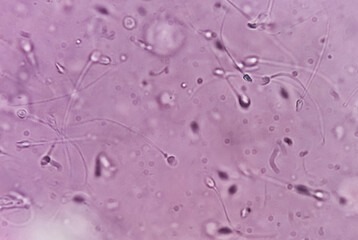 Semen analysis. Normozoospermia analyzed by microscope. Normal sperm count and morphology. 400x...