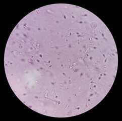 Semen analysis. Normozoospermia analyzed by microscope. Normal sperm count and morphology. 400x zoom image. - obrazy, fototapety, plakaty