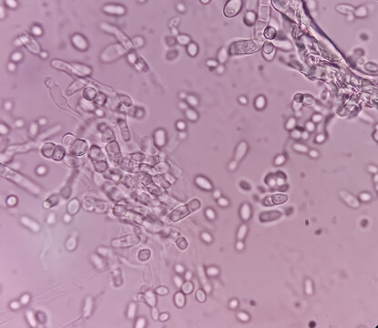 Malt Extract Agar in Petri dish using for growth media to isolate and cultivate yeasts, molds and fungal testing from Neil scraping samples. Neil scraping for fungus culture.