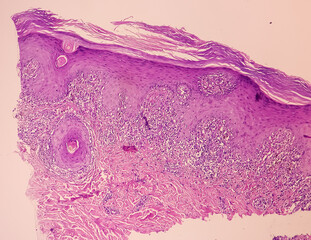 Skin tissue biopsy: Lichen planus. show skin tissue, epidermis show hyperkeratosis, acanthosis,...