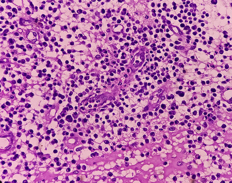 Ear (biopsy): Microphotograph of Granulation tissues, show dense infiltration of polymorphs, lymphocytes, histiocytes and foreign body giant cell. proliferation of fibroblasts, keratinocytes.