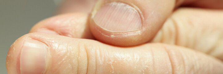 Patient shows eczema on fingers caring about skin health