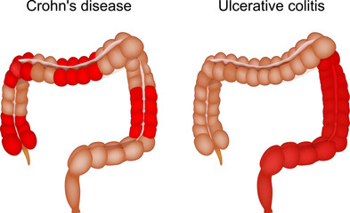 Inflammatory bowel disease. large intestine. Crohn disease and Ulcerative colitis.