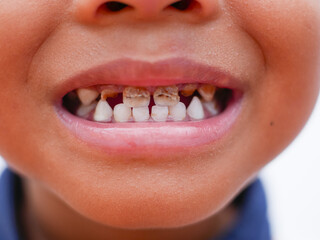 close up of black boy showing caries on teeth. health and dental care