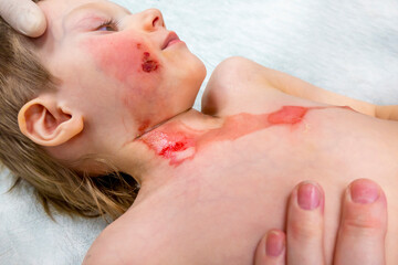 medical procedure dressing a boy with a first-degree burn from boiling water on his face, neck and...