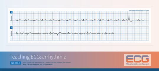 Ventricular premature contractions are a common arrhythmia, but they do not necessarily indicate that patients may have organic heart disease, and may only be idiopathic arrhythmias.