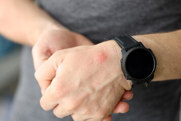 Closeup of red spot on skin of man hand. Insect bite treatment concept