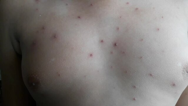 close up body of elementary age boy itching due to chickenpox. Wellness home care treatment chickenpox because varicella zoster virus. Selective focus