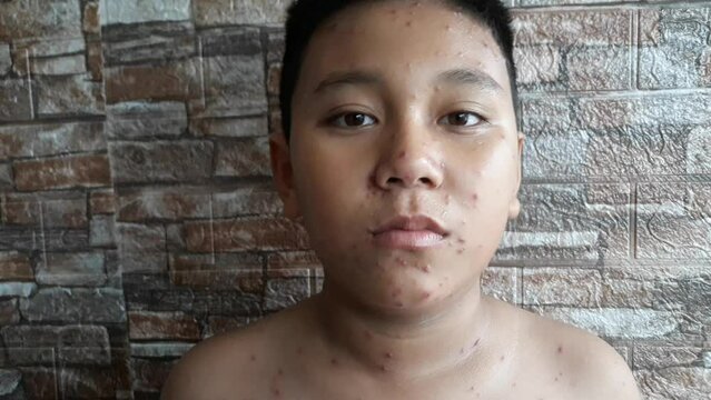 close up portrait of elementary age boy itching due to chickenpox. Wellness home care treatment chickenpox because varicella zoster virus. Selective focus