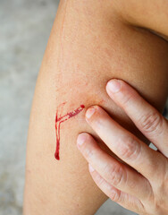 Wound and bleeding at calf of the leg, Red blood, Gash in skin, Cement background, Close up shot,...