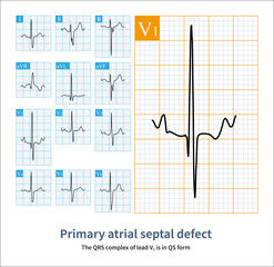 A 7-year-old male patient with a primary foramen atrial septal defect was clinically diagnosed. The electrocardiogram shows right ventricular hypertrophy and intraventricular block pattern.