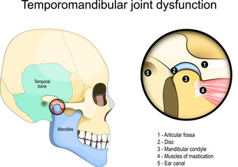 Temporomandibular joint dysfunction syndrome. Side view of a Human skull