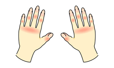 手荒れ 両手