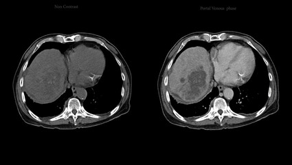 CT upper abdomen axial view  NC, A phase , V phase and delayed phase DDX is atypical HCC or hepatocellular carcinoma. - obrazy, fototapety, plakaty