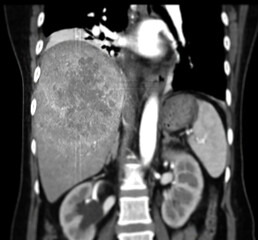CT upper abdomen coronal showing  DDX is atypical HCC or hepatocellular carcinoma. - obrazy, fototapety, plakaty