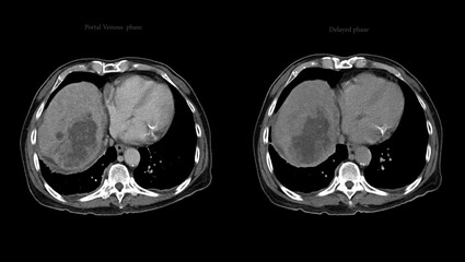 CT upper abdomen DDX is atypical HCC or hepatocellular carcinoma. - obrazy, fototapety, plakaty