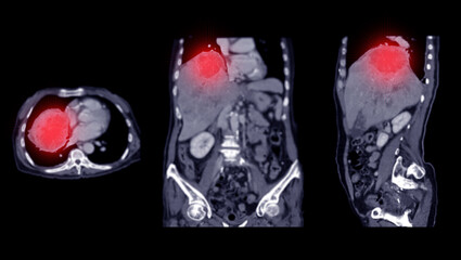 CT upper abdomen DDX is atypical HCC or hepatocellular carcinoma.