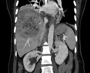 CT upper abdomen coronal view showing  DDX is atypical HCC or hepatocellular carcinoma.
