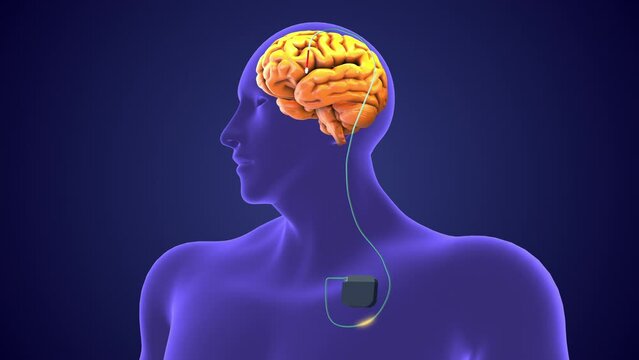 Deep brain stimulation medical concept