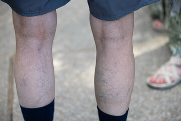 Varicose veins on men's legs. Treatment of varicose veins. - obrazy, fototapety, plakaty