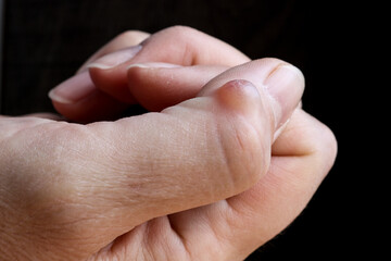 Ganglion cyst (synovial cyst disease) on the thumb of a woman’s hand. Selective focus. - obrazy, fototapety, plakaty