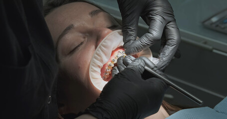 Orthodontist unfastens lock of braces in woman's mouth and removes metal arc. Close-up, work of...