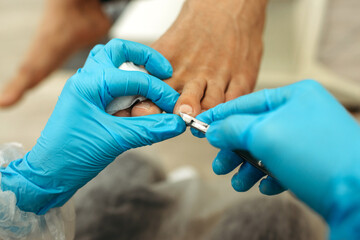 orthopedic doctor in blue gloves doing foot treatment