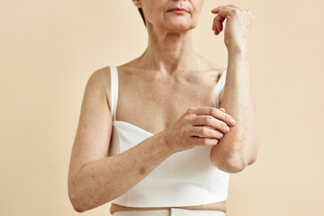 Minimal closeup of mature woman with psoriasis spot on arms, skin condition concepts