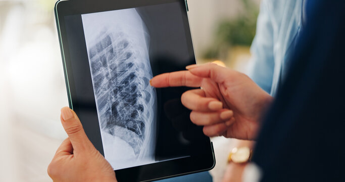 Healthcare, x ray and tablet for hand in closeup by pointing of injury on screen in consulting. Medical professional, doctor or person for technology of results, diagnosis or bone fracture of patient