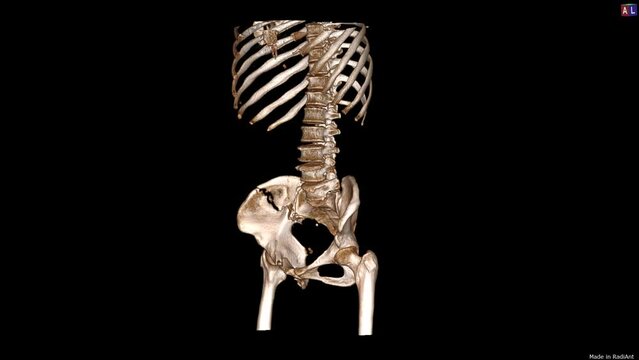 3D ct scan of  pelvis fracture
