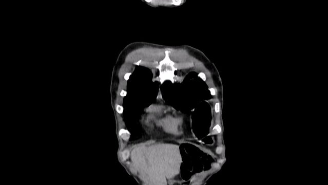 Diaphragmatic hernia  or Hiatus hernia, CT scan
