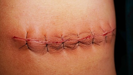 Surgical stitches was made by surgeon at the end of surgery. - obrazy, fototapety, plakaty