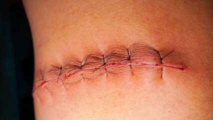 Surgical stitches was made by surgeon at the end of surgery.
