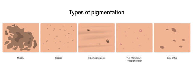 Types of pigmentation vector. Melasma, Freckles, Seborrheic keratosis, Post Inflammatory
Hyperpigmentation and Solar lentigo.