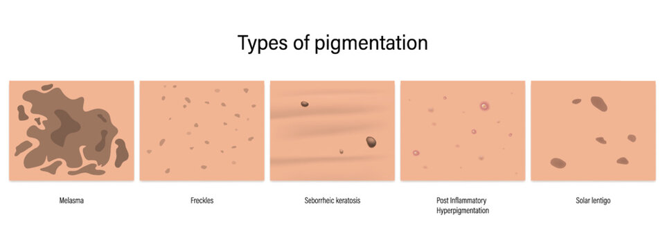 Types of pigmentation vector. Melasma, Freckles, Seborrheic keratosis, Post Inflammatory
Hyperpigmentation and Solar lentigo.