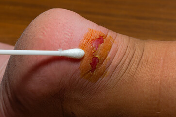 Doctor provides first aid, treats a wound - a callus on a child's foot