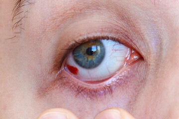 Close up of a bloodshot eye man. Hemorrhage of the eye, rupture of a vessel in the eye, blood in...