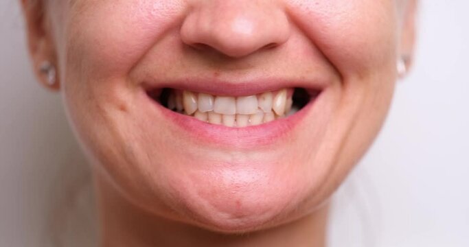 Restoration of chipped teeth and injuries and damage. Closeup of smiling woman with chipped front tooth