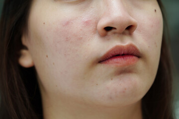 Obraz premium Acne pimple and scar on skin face, disorders of sebaceous glands, teenage girl skincare beauty problem.