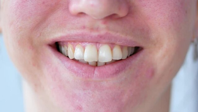 dentistry, smile of a woman with a dental stone close-up. Large teeth, plaque, malocclusion, caries.