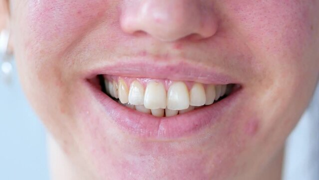 dentistry, smile of a woman with a dental stone close-up. Large teeth, plaque, malocclusion, caries.