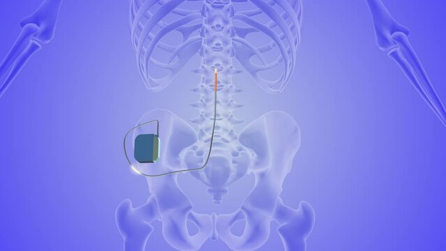 The medical notion of spinal cord stimulation 