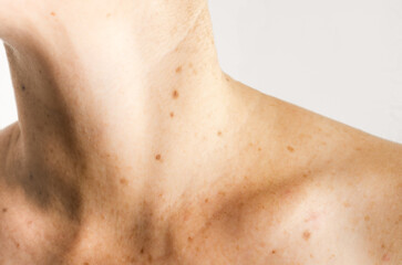Upper torso of white woman with nevus, moles, spots on the skin, isolated white background. Skin diseases. Insolation. Sun spots. Close up.