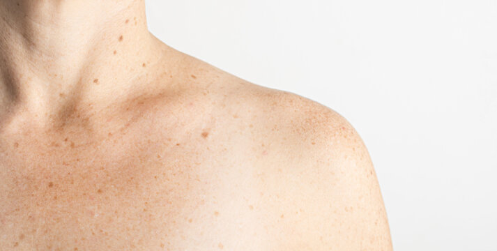Upper torso of white woman with nevus, moles, spots on the skin, isolated white background. Skin diseases. Insolation. Sun spots. Close up.