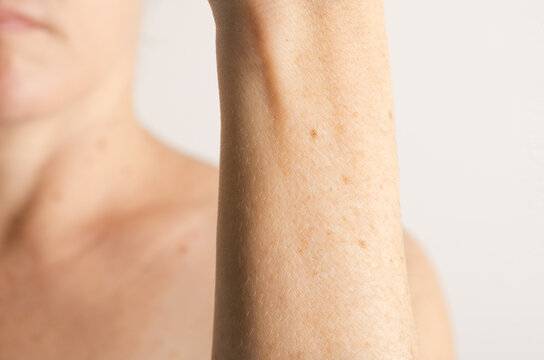 Forearm of white woman arm, nevus, moles, spots on the skin, isolated white background. Skin diseases. Insolation. Sun spots. Close up. Dermatology. Skin cancer.
