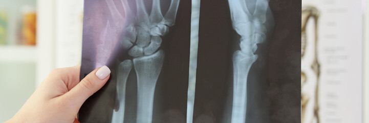 X-ray image of patient palm bones in orthopedist hand