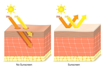 UV Protection. Penetration into the human skin. The difference between skin without sunscreen lotion and skin with sun protection lotion. UVA and UVB radiographs of skin damage.