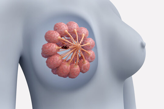 Breast cancer on woman chest for cancer treatment and medical concept. 3D rendering.