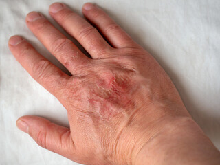Thermal burn of the skin of the hand close-up. Healing wound, injury.