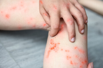 atopic dermatitis on the legs of a child